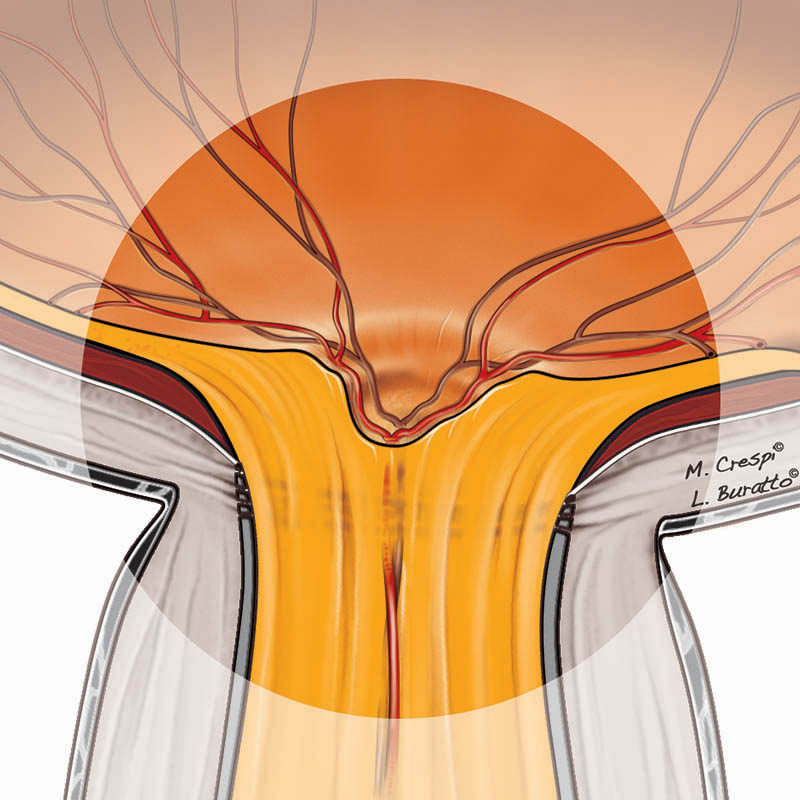 Evoluzione del glaucoma