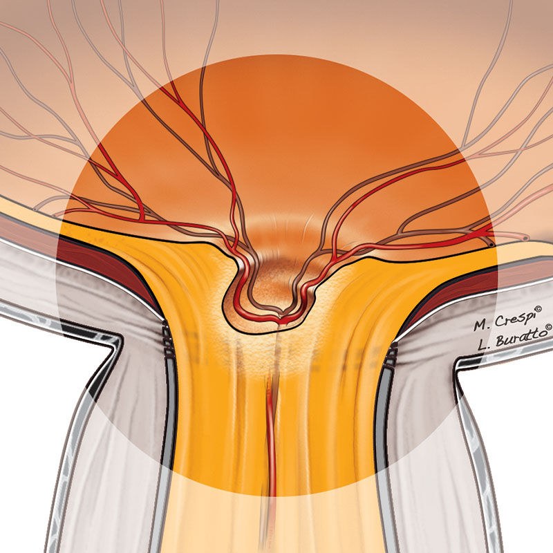 Evoluzione del glaucoma