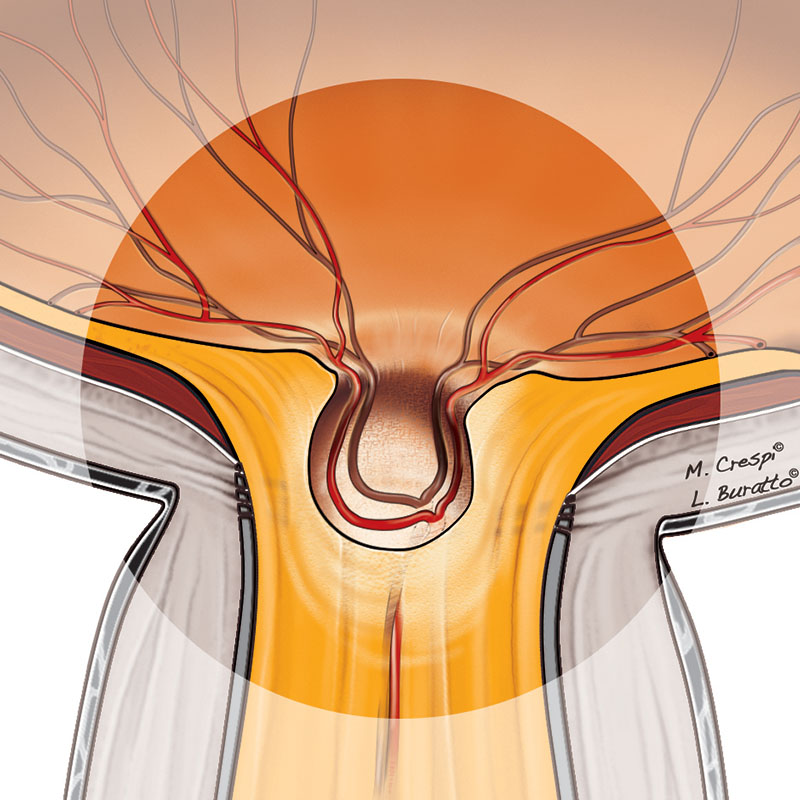 Evoluzione del glaucoma