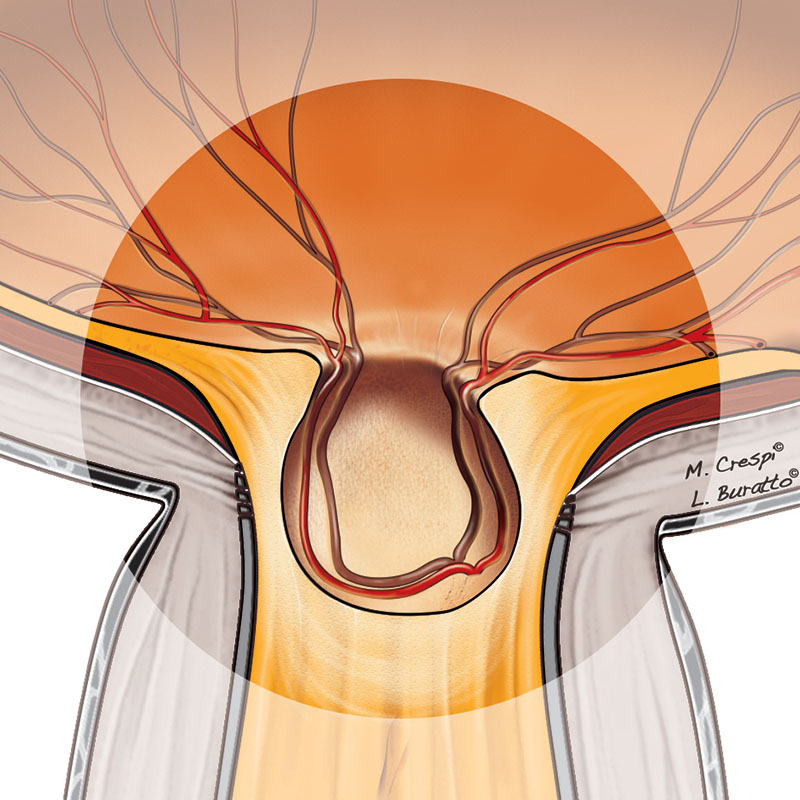 Evoluzione del glaucoma