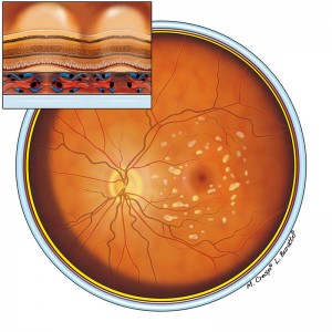 Maculopatia iniziale