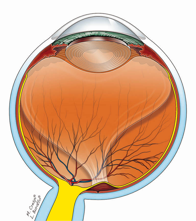 Trazione vitreo-maculare