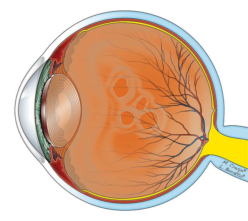 Distacco posteriore di vitreo