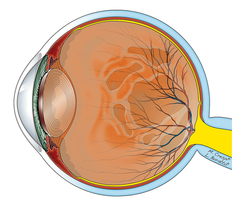 Distacco posteriore di vitreo