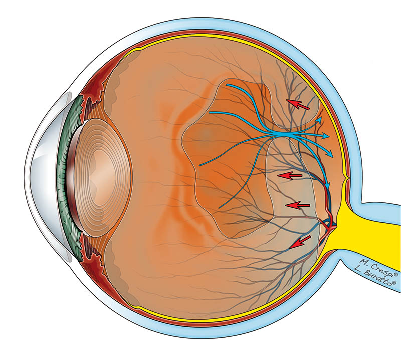 Distacco posteriore di vitreo