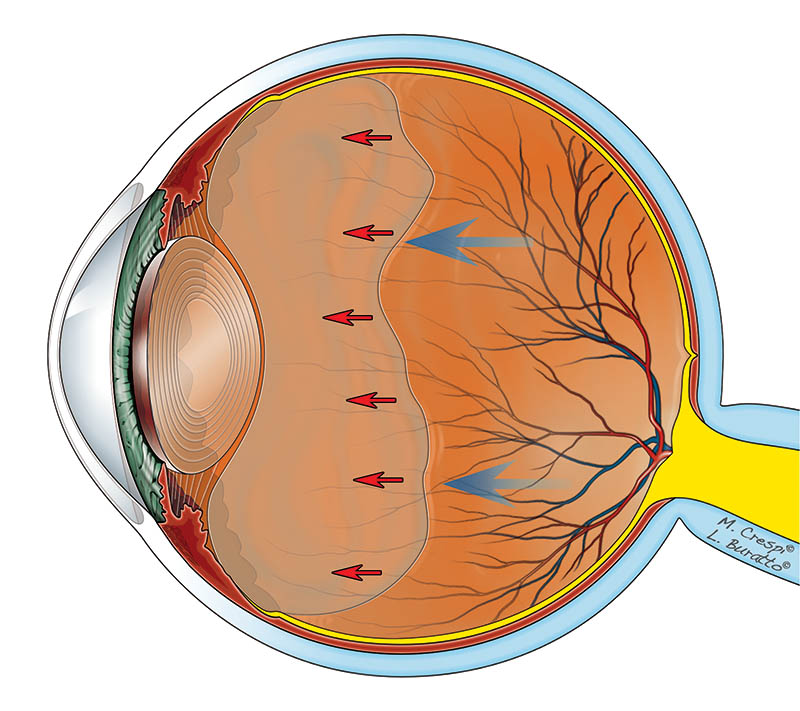 Distacco posteriore di vitreo