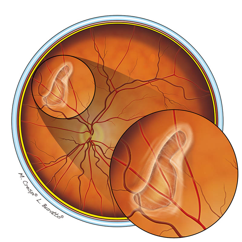 Rotture retiniche ed aderenze vitreo-retiniche anomale