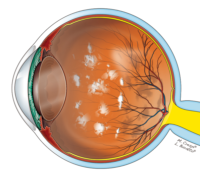 Miodesopsie o Corpi mobili vitreali